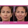 Exfoliation Professional Facial Diamond Microdermabrasion