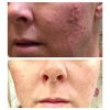 Acne Scarring, Wrinkles Acid Skin Peel
