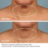 Revitalize Your Profile with StriVectin TL Advanced Tightening Neck Cream - 1.7 Fl Oz