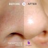 Blackhead Remover Vacuum Suction Facial Pore Cleaner