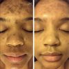 Ultra-Potent Brightening Serum Dark Spot Corrector Remover