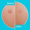 Tea Tree Oil and Hydrocolloid Pimple Patches for Face