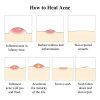 Acne Treatment Serum Remover Pimple and Repair Skin