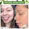 Acne Treatment Cream TEA TREE OIL