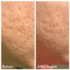 Exfoliating Facial Scrub for Face Acne Scars & Remove Blackheads