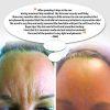 Exfoliating Facial Scrub for Face Acne Scars & Remove Blackheads