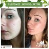 Acne Treatment Cream TEA TREE OIL