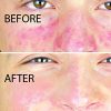 Redness and Bumps Treatment and Prevention
