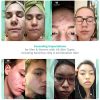 Pore Minimizer Facial Astringent Acne Treatment