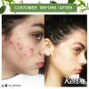 Acne Treatment Cream TEA TREE OIL