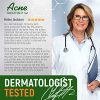 Cystic Acne Treatment and Acne Scar Remover