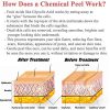 Glycolic Acid Peel - Chemical Peel For Face