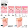 Anti Aging Skin Tightening- Wrinkle Reduction