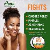 Cystic Acne Treatment and Acne Scar Remover