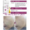 Anti Acne Cream Repair Skin Care Treatment Mango Face Beauty