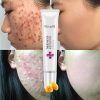 Anti Acne Cream Repair Skin Care Treatment Mango Face Beauty