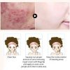 Anti-acne Cream Acne Blackhead Face Cream Treatment
