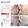 Anti-acne Cream Acne Blackhead Face Cream Treatment