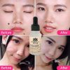 Dark Spot Removal Face Wart Tag Freckle Removal