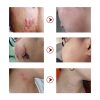 Scar Removal Cream Acne Treatment Repairing Scar Pigmentation