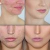 Tree Pure Essential Oil Face Care Skin Acne
