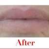 Fullips Lip Plumping Tool -Small Oval Plus