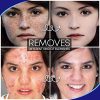 Blemish Treatment for Face, Blackhead Removal Cream