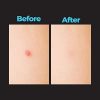 Cystic Acne Patches Treatment Zit Patch Acne Dots