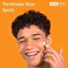 Acne Spot Treatment with Benzoyl Peroxide