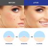 Salicylic Acid Acne Treatment Pimple Treatment Patch