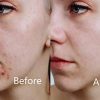 LED Facial Skin Care Mask Light Treatment