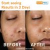 Acne Treatment Kit w Oil Free Acne Cleanser, Witch Hazel Toner