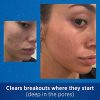 Acne Spot Treatment for Face with Adapalene