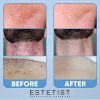 Skin Care Treatment for Face Razor Bump Stopper Solution for Ingrown Hair