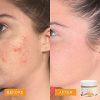 Aloe Vera Acne Face Cleanser with Salicylic Acid - Best Acne Wash for Clear Skin