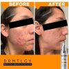 Spot Treatment and Cystic Acne Treatment Peroxide 5% and Glycolic Acid