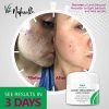 Acne Cream Cystic Acne Spot Treatment for Face
