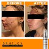 Spot Treatment and Cystic Acne Treatment Peroxide 5% and Glycolic Acid
