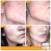 Aloe Vera Acne Face Cleanser with Salicylic Acid - Best Acne Wash for Clear Skin