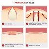 ALDOM Acne Pimple Patches, Hydrocolloid Acne Patch Treatment