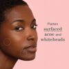Rael Acne Pimple Healing Patch - Microneedle Acne Spot, Absorbing Cover