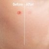 Acne Patches (120 Pack), Hydrocolloid Acne Patch with Tea Tree Oil