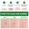 Acne Pimple Healing Patch - Absorbing Hydrocolloid Blemish Spot Skin Treatment