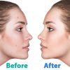 Hydrocolloid Acne Patches Large - Invisible Blemish Spot Skin Treatment