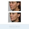 NuFACE Anniversary Complete Facial Toning Kit | Trinity Facial Device