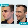 Proactiv 3 Step Acne Treatment - Benzoyl Peroxide Face Wash