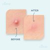Claene Hydrocolloid Pimple Patches With Tea Tree Oil For Acne