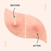 Rael Acne Pimple Healing Patch - Absorbing Cover, Invisible, Blemish Spot