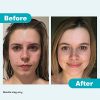 ProactivMD Adapalene Gel Acne Kit – Complete Retinol-Based Skincare with Cleanser, Toner & SPF Moisturizer