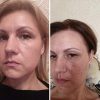 Luxury Dark spot remover for Face and Body Serum